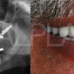 Case Studies Εμφυτεύματα | Dental Implants